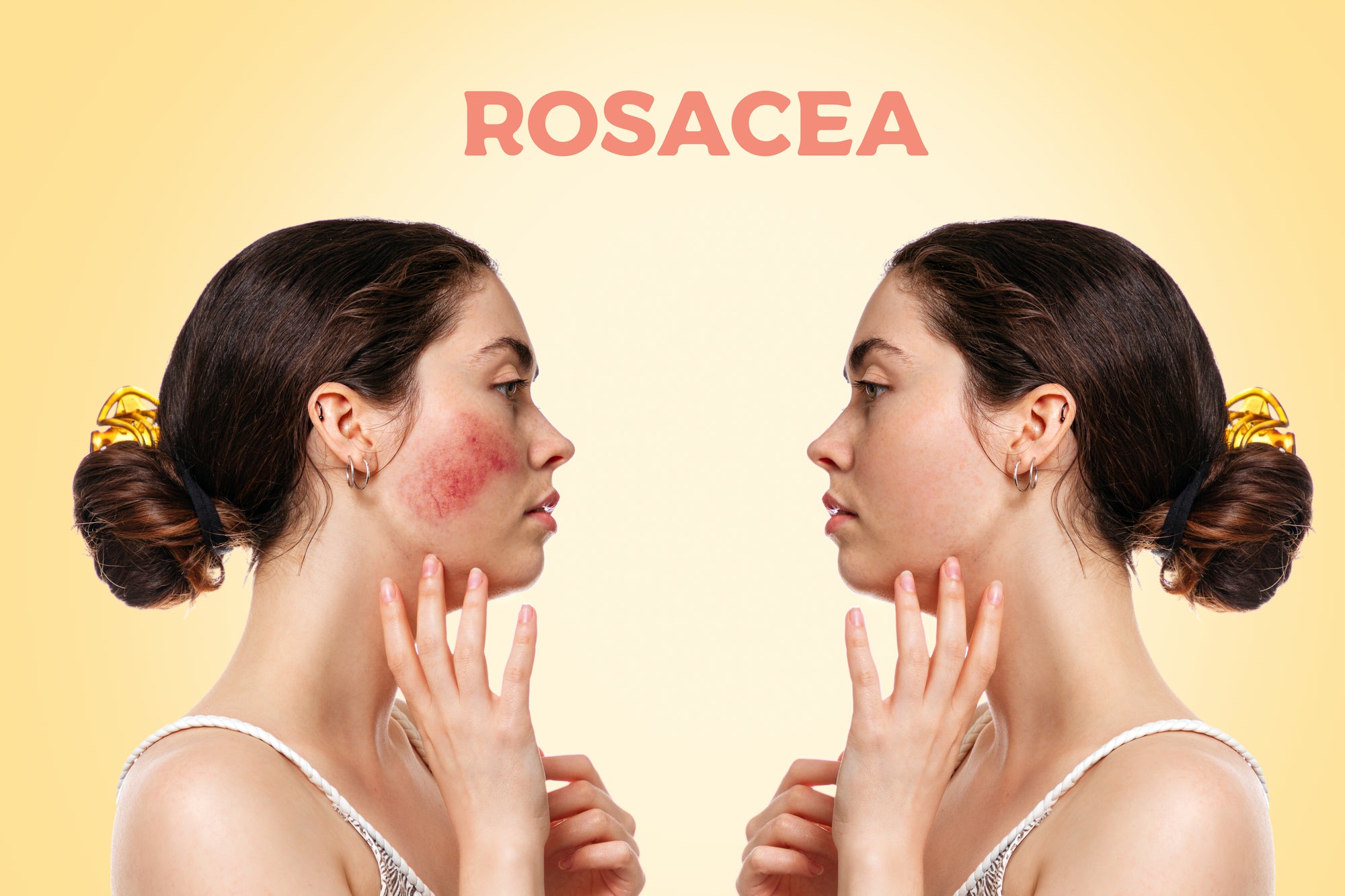 Rosacea Face Mask - PURE SKIN FOOD