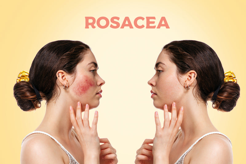 Rosacea skin care: Bye bye bye to redness!