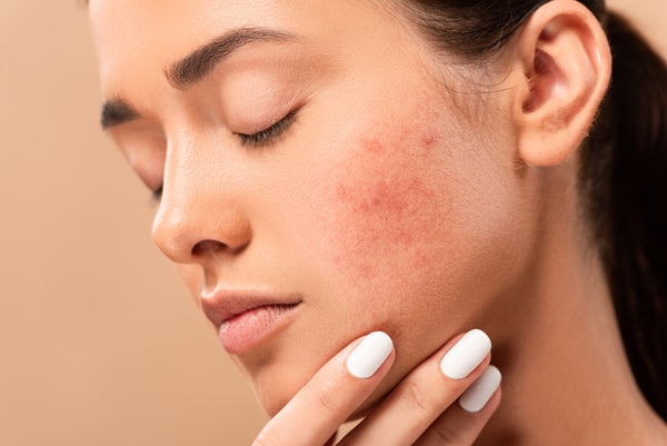 a girl with acne scar